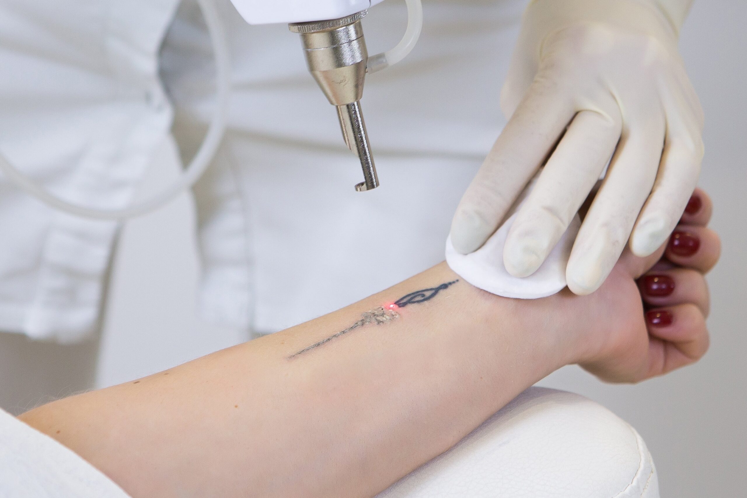 Tattoo Removal in Chandigarh