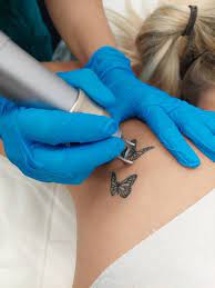 Laser Tattoo Removal in Chandigarh